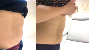 Fett Weg spritze Erfahrung docboom vorher nachher